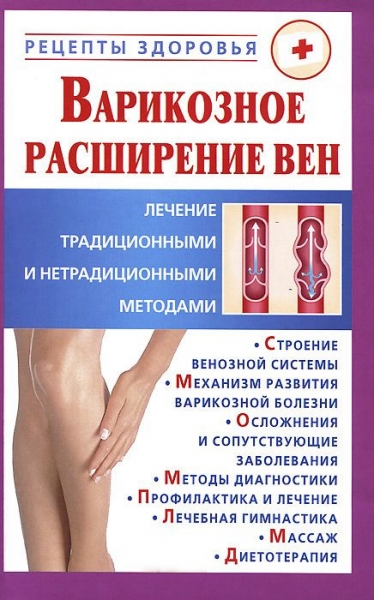 Варикозное расширение вен.